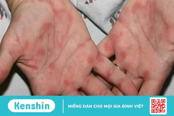 Triệu chứng HIV sau 4 năm như thế nào? 3