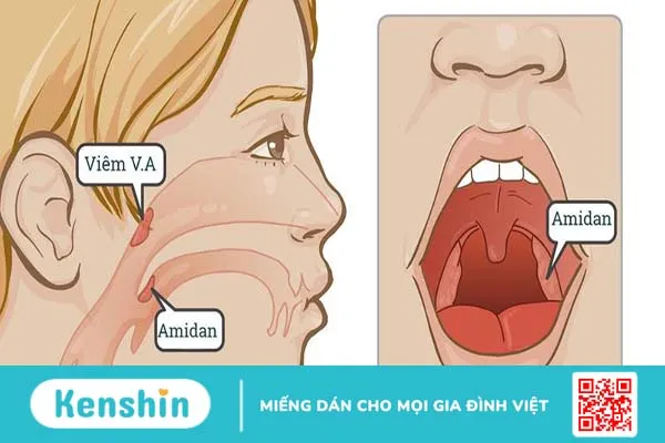 Triệu chứng và cách điều trị viêm VA mãn tính ở trẻ 1