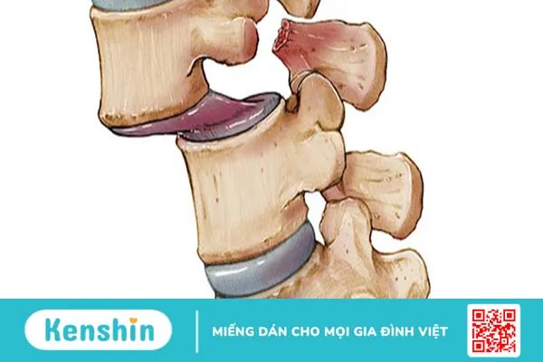 Trượt đốt sống ra trước (L4,L5) và những điều cần biết 1