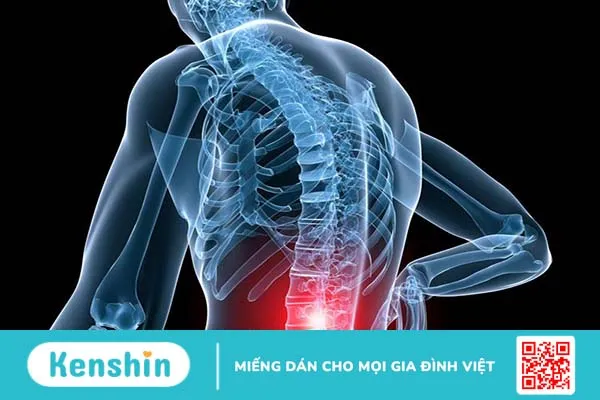 Trượt đốt sống ra trước (L4,L5) và những điều cần biết 3