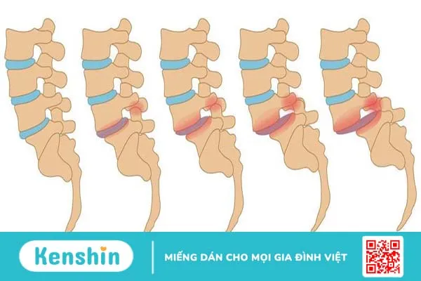 Trượt đốt sống thắt lưng và những điều người bệnh cần chú ý 1