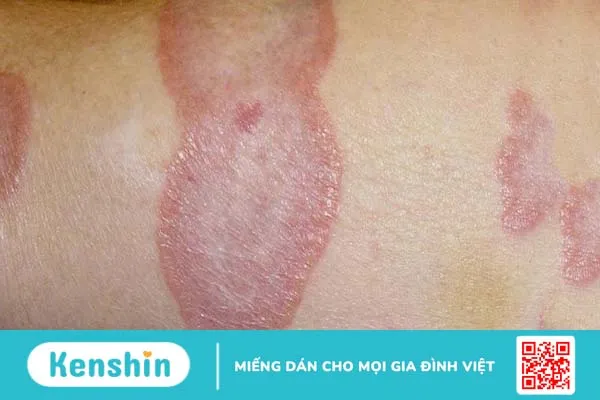 Tư vấn da liễu: Ghẻ lở hắc lào có lây không 1