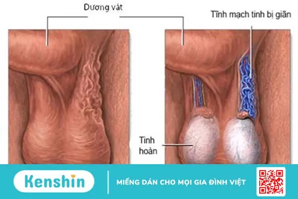 Túi giãn tĩnh mạch bìu là gì? Nguyên nhân và phương pháp điều trị 2