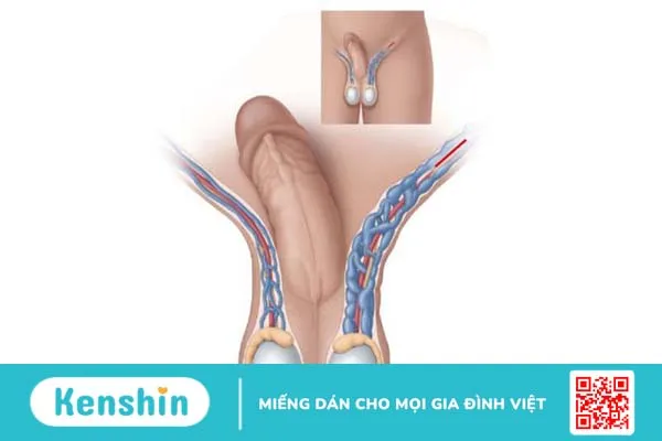 Túi giãn tĩnh mạch bìu là gì? Nguyên nhân và phương pháp điều trị 3