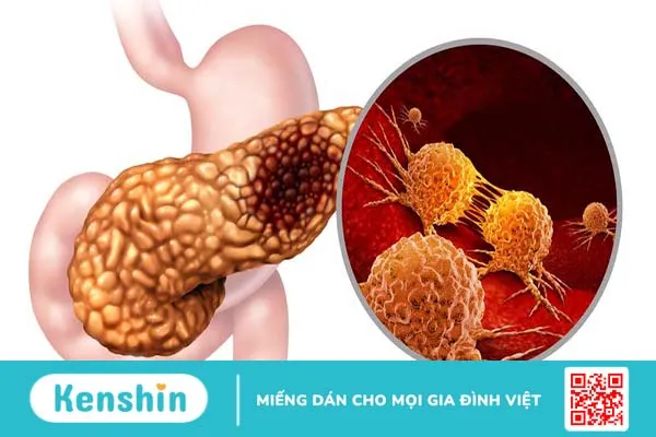 Tuyến tụy liên quan đến bệnh tiểu đường như thế nào? 4