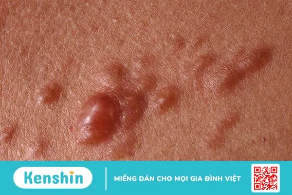 U cơ trơn ở da là gì? Nguyên nhân, triệu chứng và cách điều trị 2