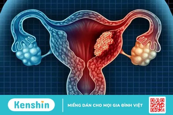 Khi xuất hiện tình trạng vỡ nang, xoắn nang cần mổ để cứu sống bệnh nhân