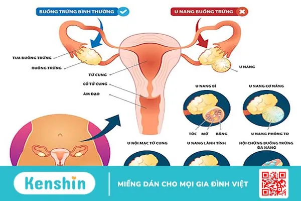 U nang buồng trứng kiêng ăn gì? Chế độ ăn phù hợp cho bệnh nhân u nang 2