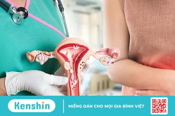 U nang buồng trứng mổ rồi có bị lại không?