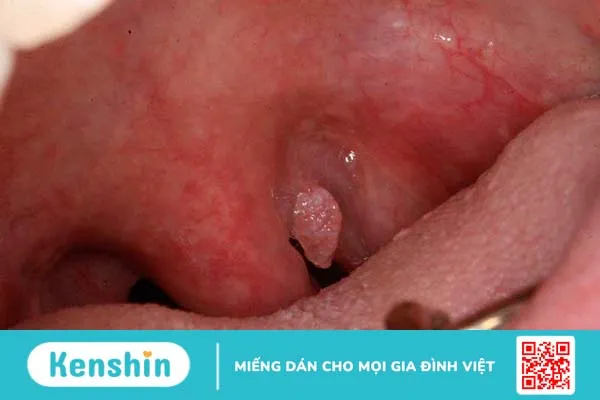 Nguyên nhân dẫn đến u nhú lưỡi gà có thể do quan hệ tình dục không an toàn