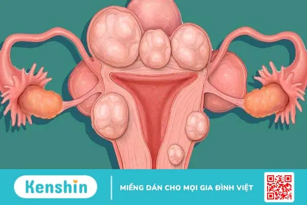 U xơ tử cung ăn gì tốt giúp bệnh nhanh khỏi 1