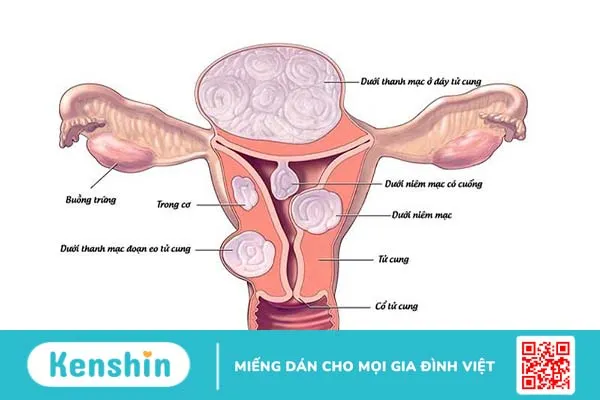 Giải đáp: U xơ tử cung có chuyển thành ung thư không? 2