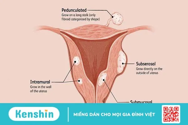 U xơ tử cung dưới niêm mạc nguy hiểm như thế nào? Có chữa được không? 1