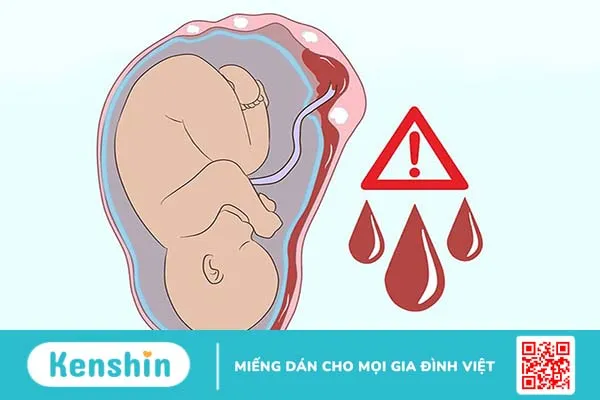 U xơ tử cung khi mang thai phải làm gì? 3