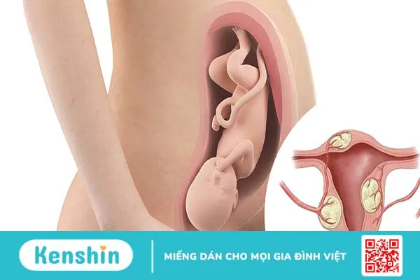 U xơ tử cung ở độ tuổi nào mắc nhiều nhất? 4