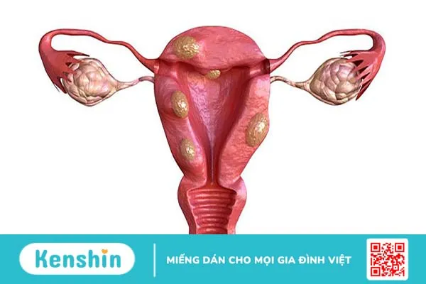 U xơ tử cung ở tuổi mãn kinh có nguy hiểm? 1