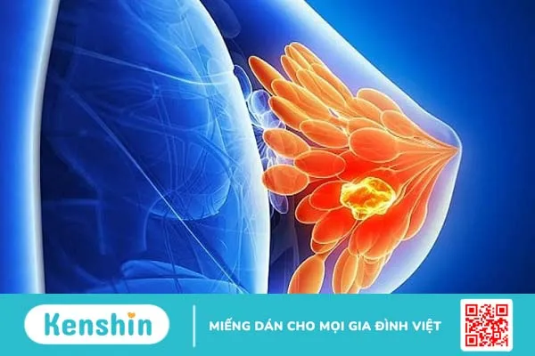 U xơ tuyến vú có nên mổ hay chỉ cần theo dõi, thăm khám định kỳ? 1