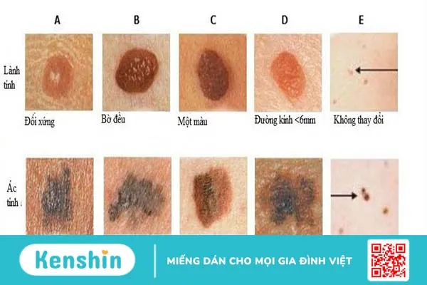 Ung thư da giai đoạn đầu có chữa được không? 3