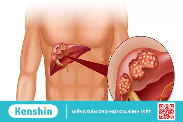 Ung thư gan nguyên phát là khi tế bào gan bị dị biến tiến triển nhanh