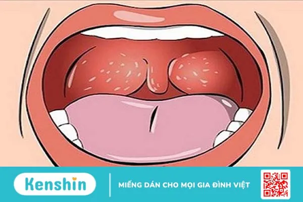 Ung thư miệng và hầu họng: Lựa chọn điều trị 1