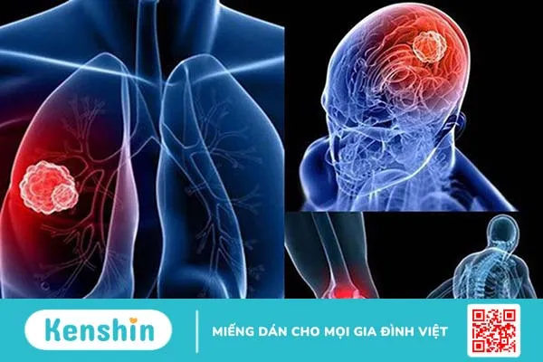 Ung thư phổi di căn não và xương có chữa được không? 1