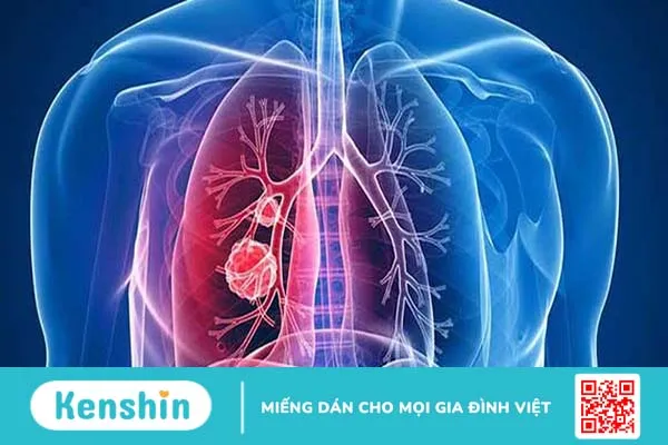 Ung thư phổi di căn não và xương có chữa được không? 2