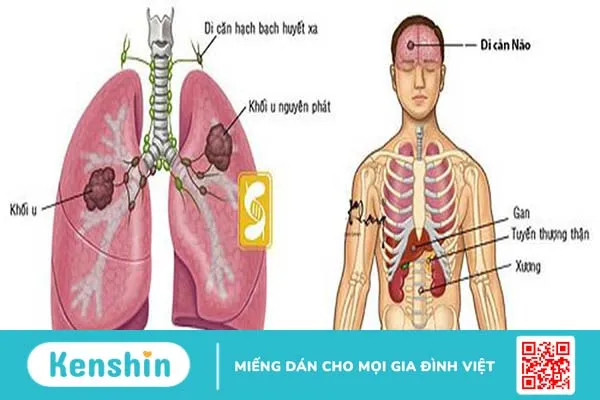 Ung thư phổi di căn não và xương có chữa được không? 3