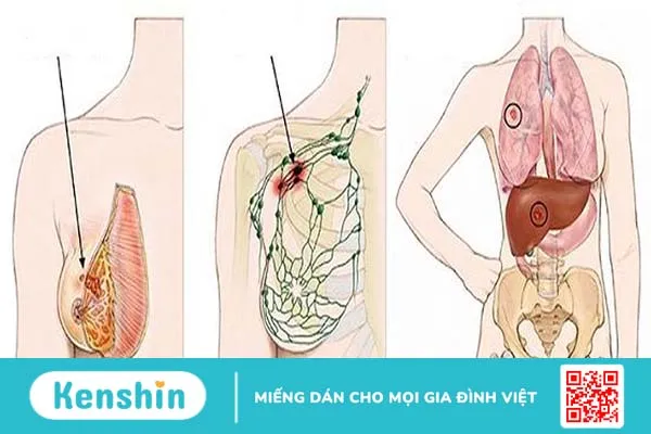 Ung thư vú lây lan di căn phổi