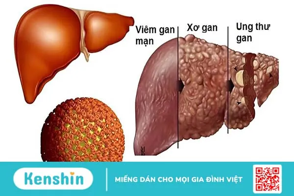 Vắc-xin TherVacB điều trị viêm gan B mãn tính bước vào thử nghiệm lâm sàng 1