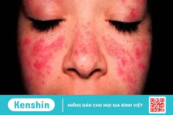 Phát ban đỏ là một trong những triệu chứng của Lupus ban đỏ