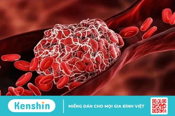 Van tĩnh mạch là gì? Triệu chứng cảnh báo van tĩnh mạch bị hỏng 1