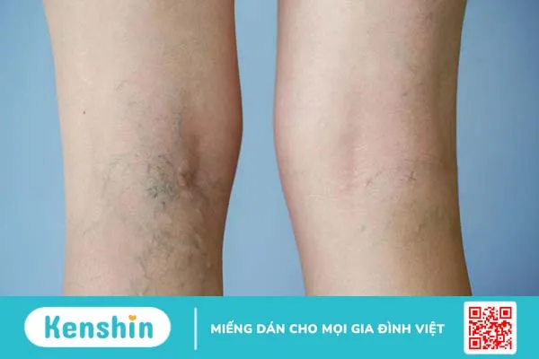 Van tĩnh mạch là gì? Triệu chứng cảnh báo van tĩnh mạch bị hỏng 3