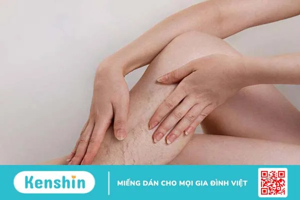 Van tĩnh mạch là gì? Triệu chứng cảnh báo van tĩnh mạch bị hỏng 4