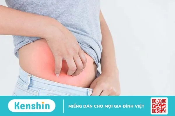 vết rạn da sau sinh bị đau 1