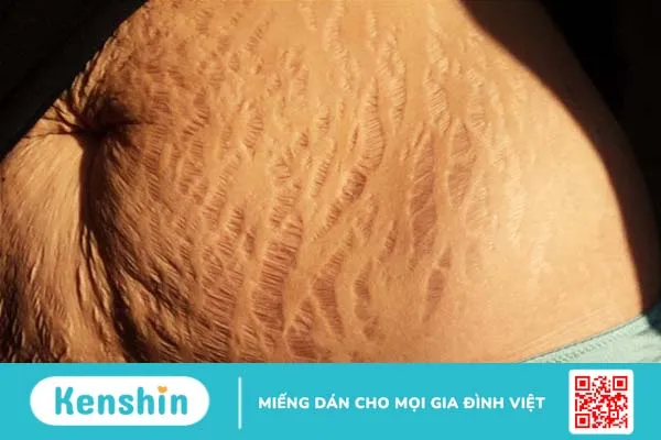 vết rạn da sau sinh bị đau 2