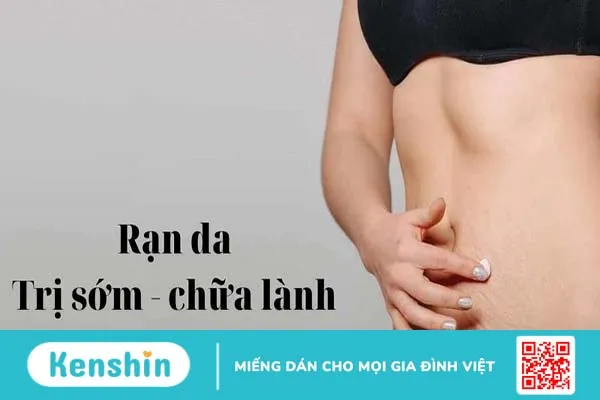 vết rạn da sau sinh bị đau 3