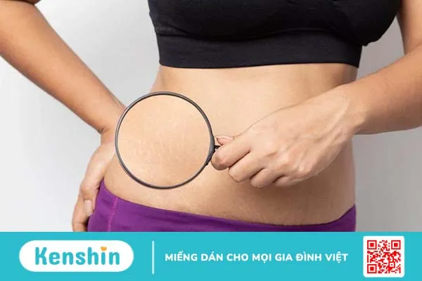 vết rạn da sau sinh bị ngứa 3