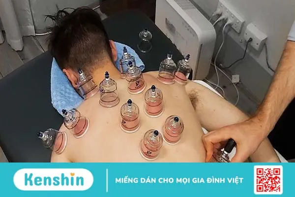 Vì sao có vết bầm tím khi giác hơi? Có ảnh hưởng đến sức khỏe không 1