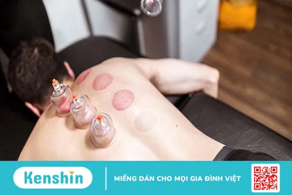 Vì sao có vết bầm tím khi giác hơi? Có ảnh hưởng đến sức khỏe không 2