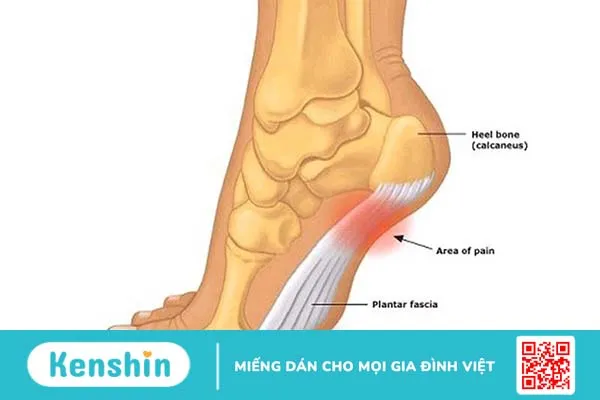 Viêm cân gan chân bao lâu thì khỏi ? Bệnh viện nào tại TPHCM có thể điều trị viêm cân gan chân lâu năm 1