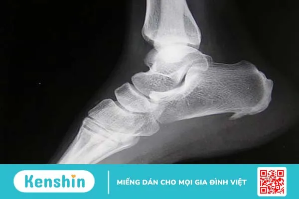 Viêm cân gan chân bao lâu thì khỏi ? Bệnh viện nào tại TPHCM có thể điều trị viêm cân gan chân lâu năm 2