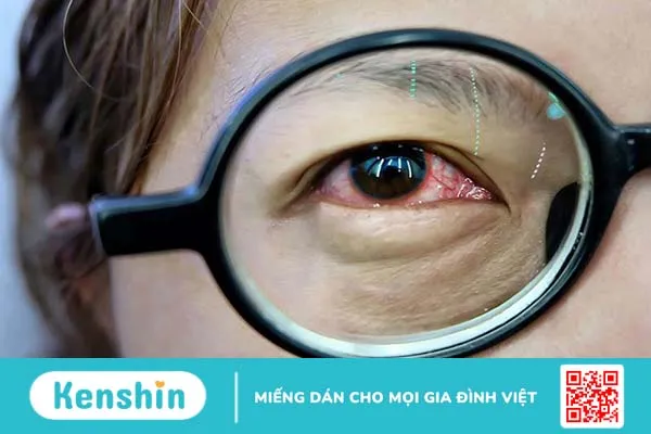 Viêm dây thần kinh mắt có nguy hiểm không? Cách chẩn đoán và điều trị bệnh thế nào? 2