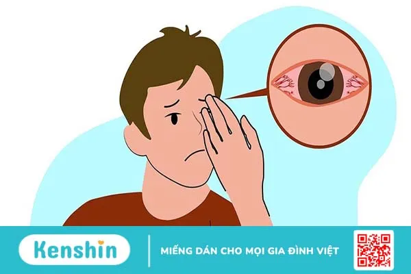 Viêm giác mạc dùng thuốc gì? 1