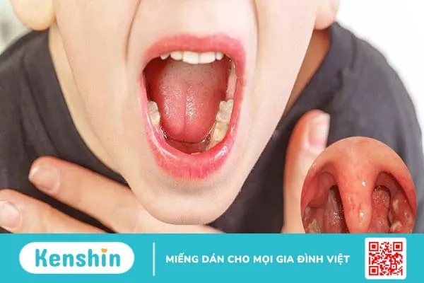 Viêm họng kéo dài mãi không dứt nguyên nhân do đâu? 4