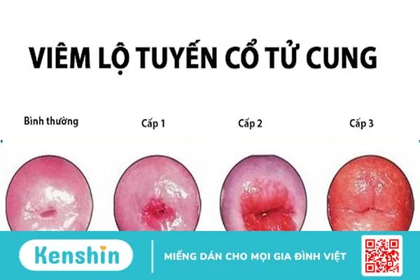 Viêm lộ tuyến cổ tử cung có nên đốt không? Khi nào nên sử dụng phương pháp “đốt” 2