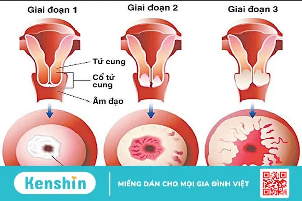 Viêm lộ tuyến tử cung có nguy hiểm không? Các phương pháp phòng chống bệnh như thế nào? 2