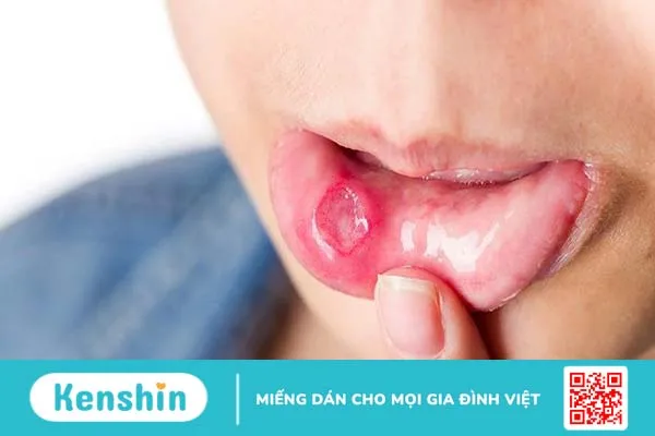 Viêm loét miệng kéo dài do đâu? 1