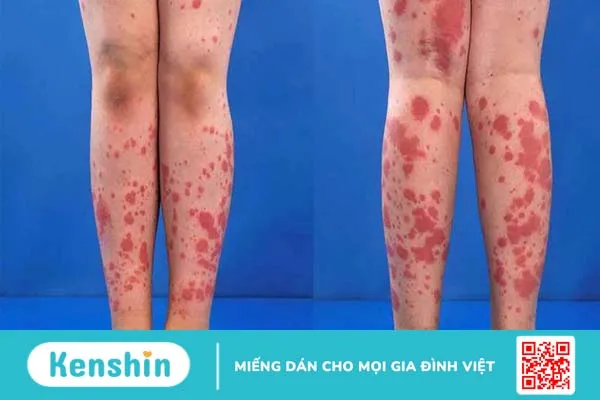 Viêm mạch máu là gì? Nguyên nhân và cách điều trị bệnh 1