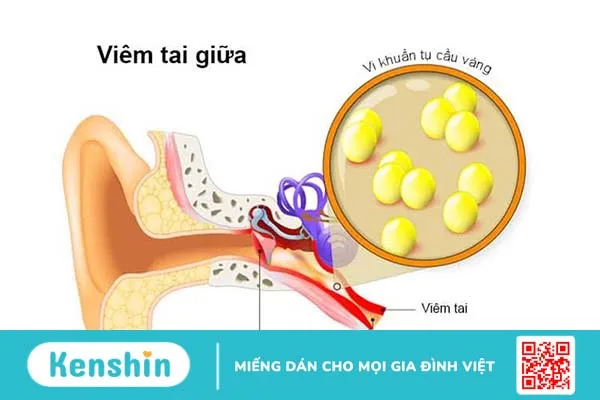 Bệnh viêm mê nhĩ là khi mê nhĩ bị nhiễm trùng do vi khuẩn ở tai trong