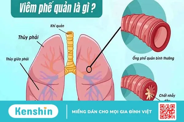 Viêm phế quản cấp: Giải đáp các câu hỏi thường gặp cùng bác sĩ 2